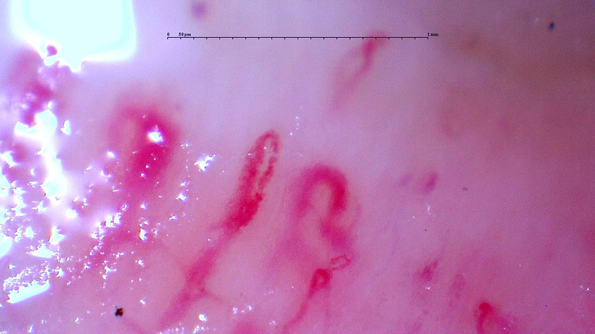 Nailfold capillaroscopy: left index finger, field d. Initial study. Anti-NXP2 Dermatomyositis with Capillaroscopic Improvement.