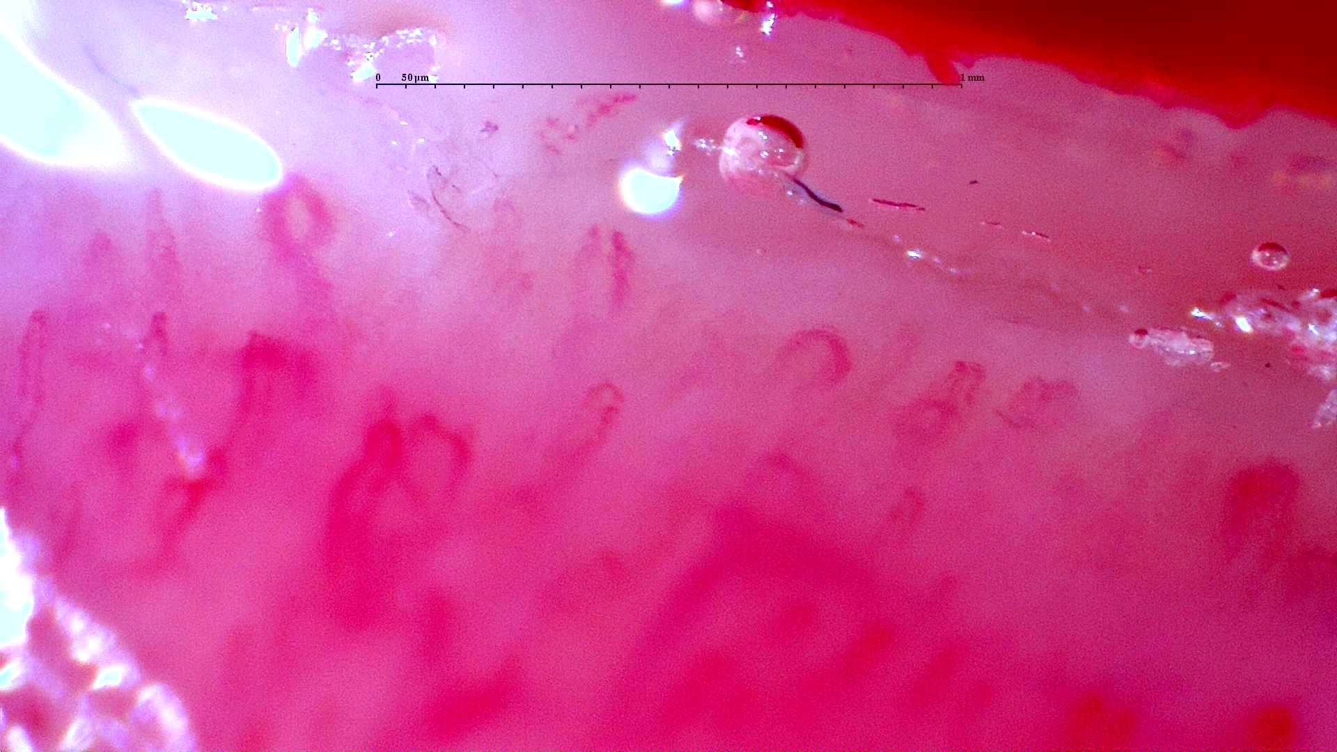 Nailfold capillaroscopy: right little finger, field b. Initial study. Anti-NXP2 Dermatomyositis with Capillaroscopic Improvement.