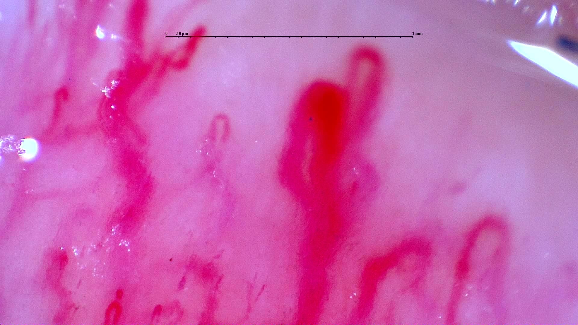 Nailfold capillaroscopy: left ring finger, field c. Initial study. Anti-NXP2 Dermatomyositis with Capillaroscopic Improvement.