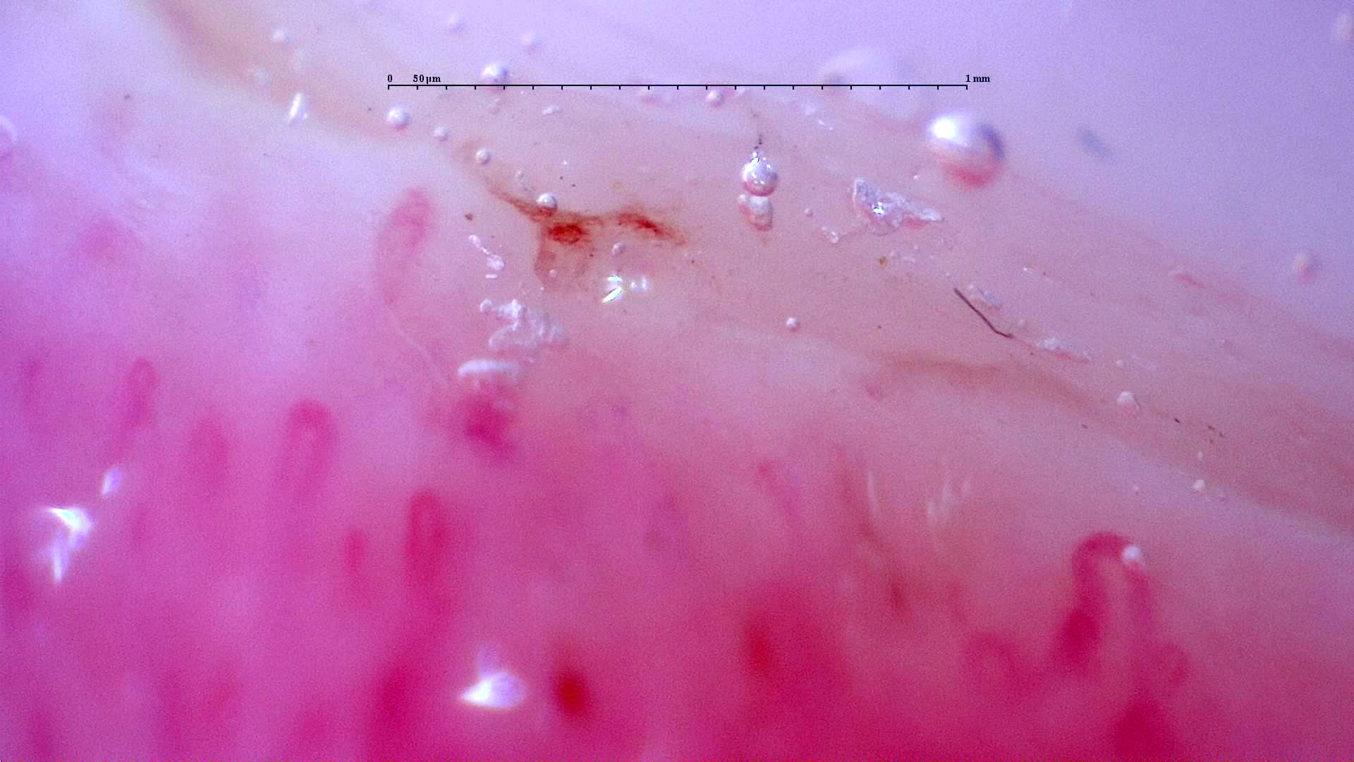 Nailfold capillaroscopy: right index finger, field a. Initial study. Anti-NXP2 Dermatomyositis with Capillaroscopic Improvement.