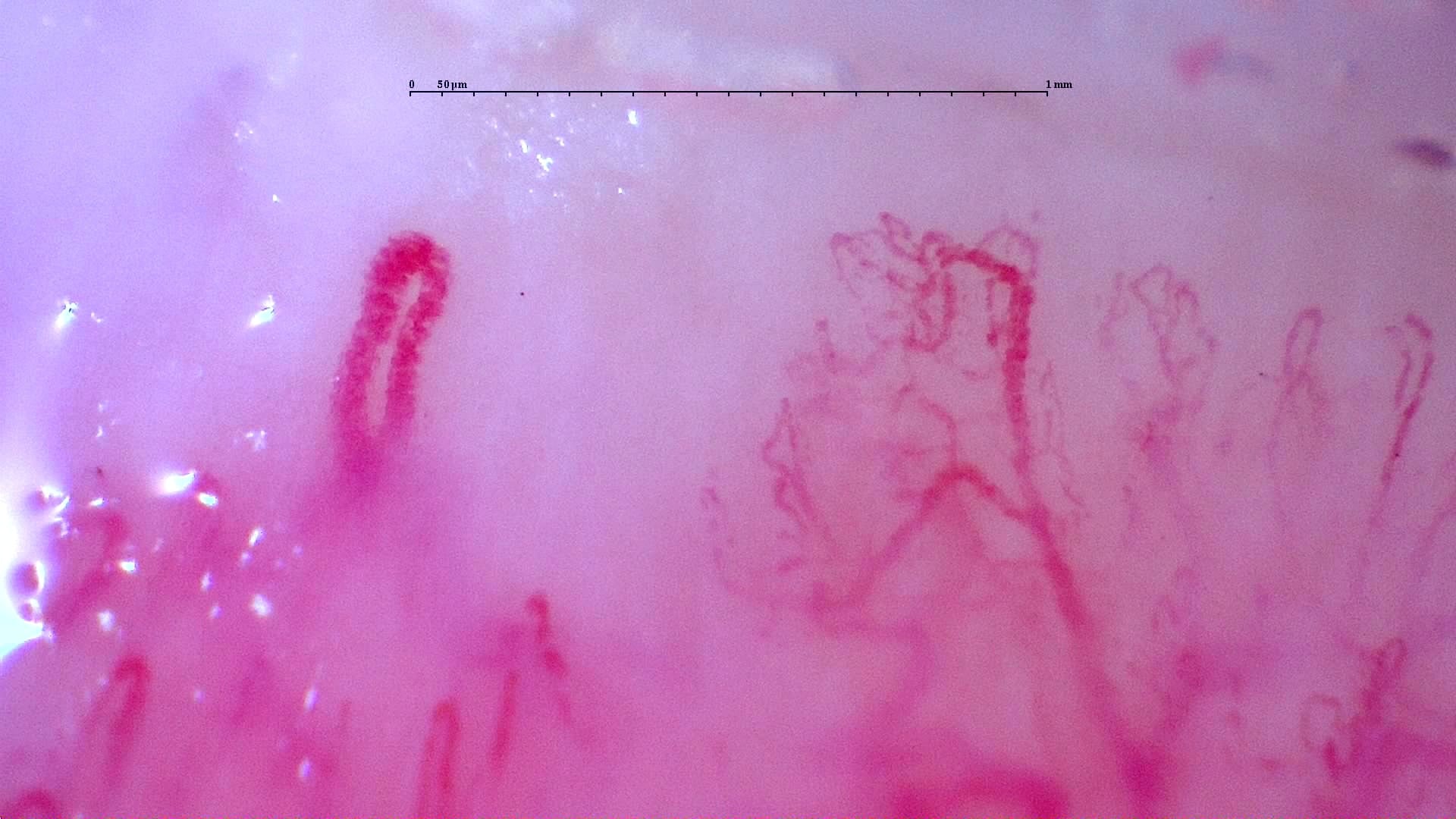 Nailfold capillaroscopy: right ring finger, field a. Initial study. Anti-NXP2 Dermatomyositis with Capillaroscopic Improvement.