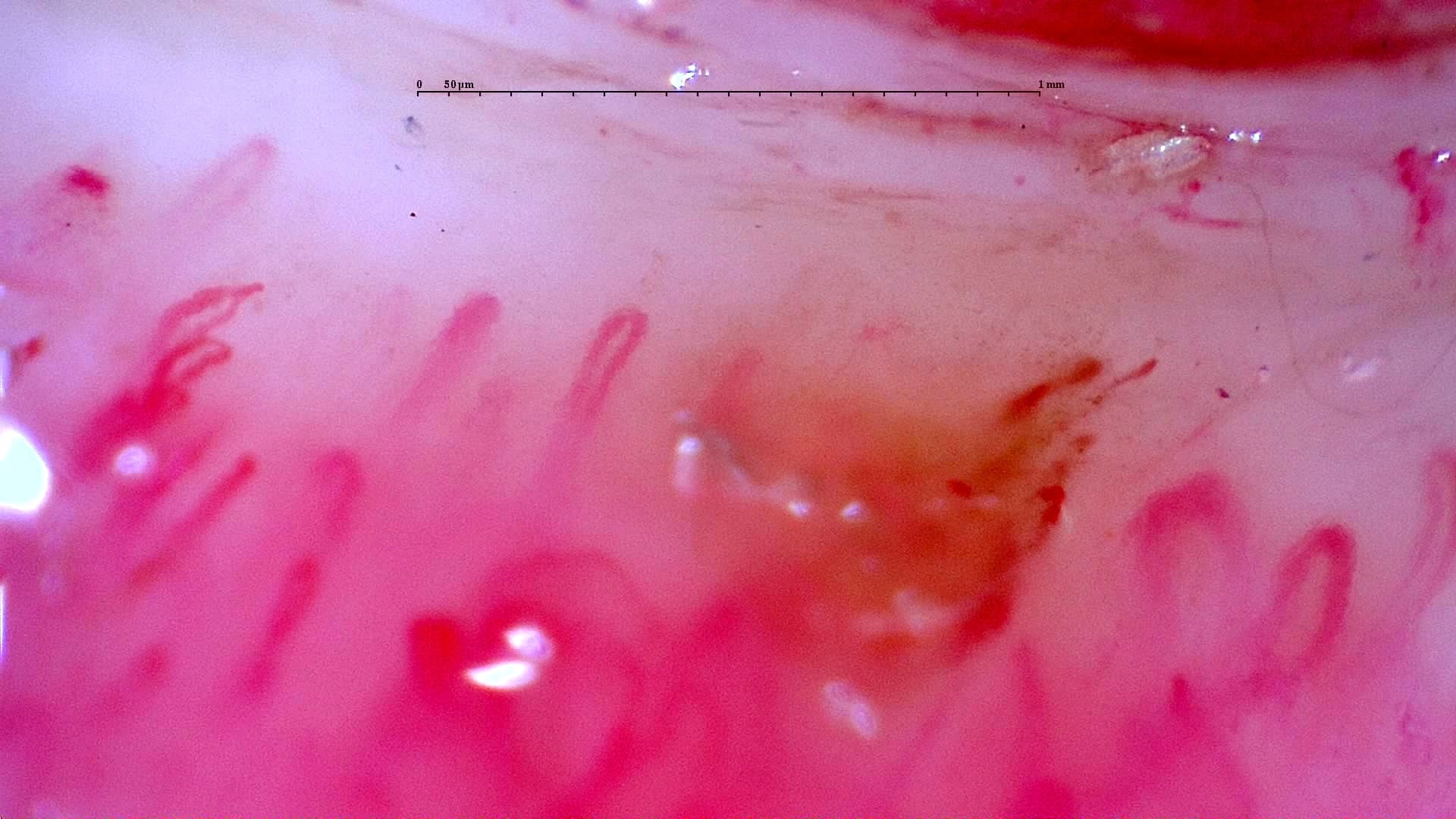 Nailfold capillaroscopy: left little finger, field b. Initial study. Anti-NXP2 Dermatomyositis with Capillaroscopic Improvement.