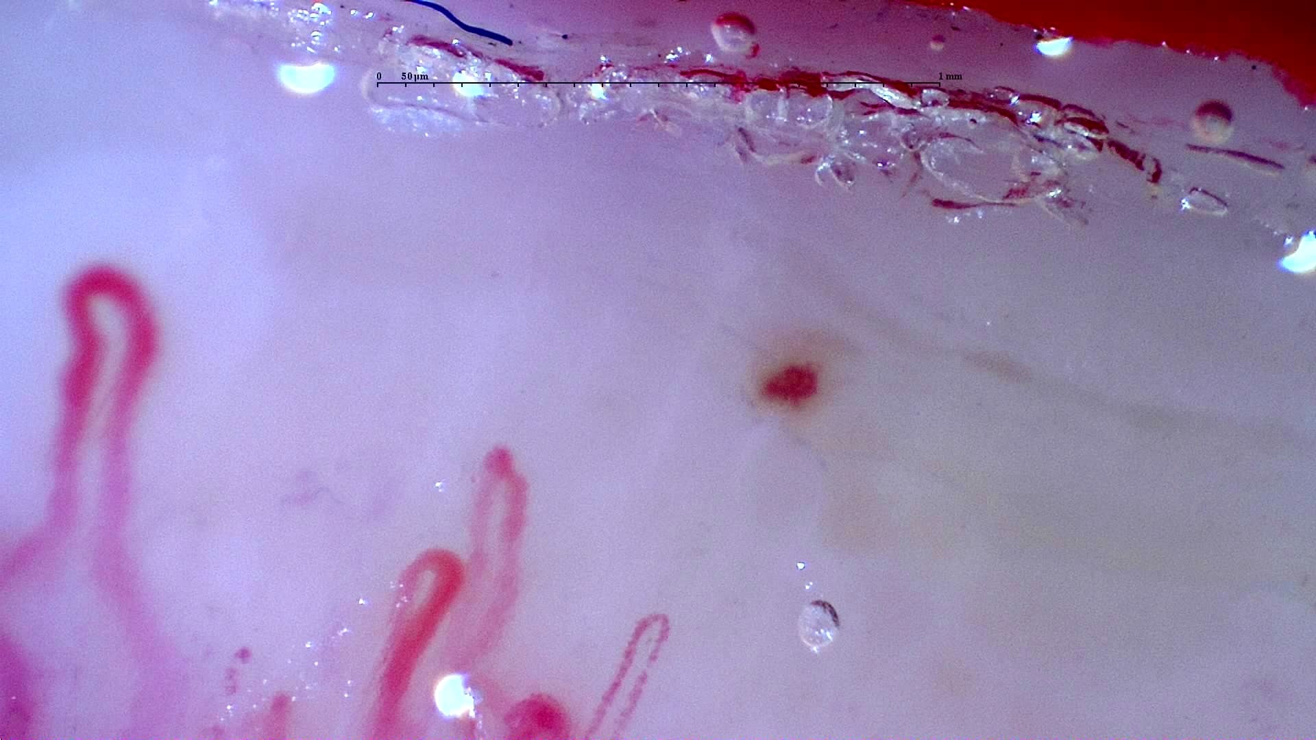 Nailfold capillaroscopy: left middle finger, field d. Initial study. Anti-NXP2 Dermatomyositis with Capillaroscopic Improvement.