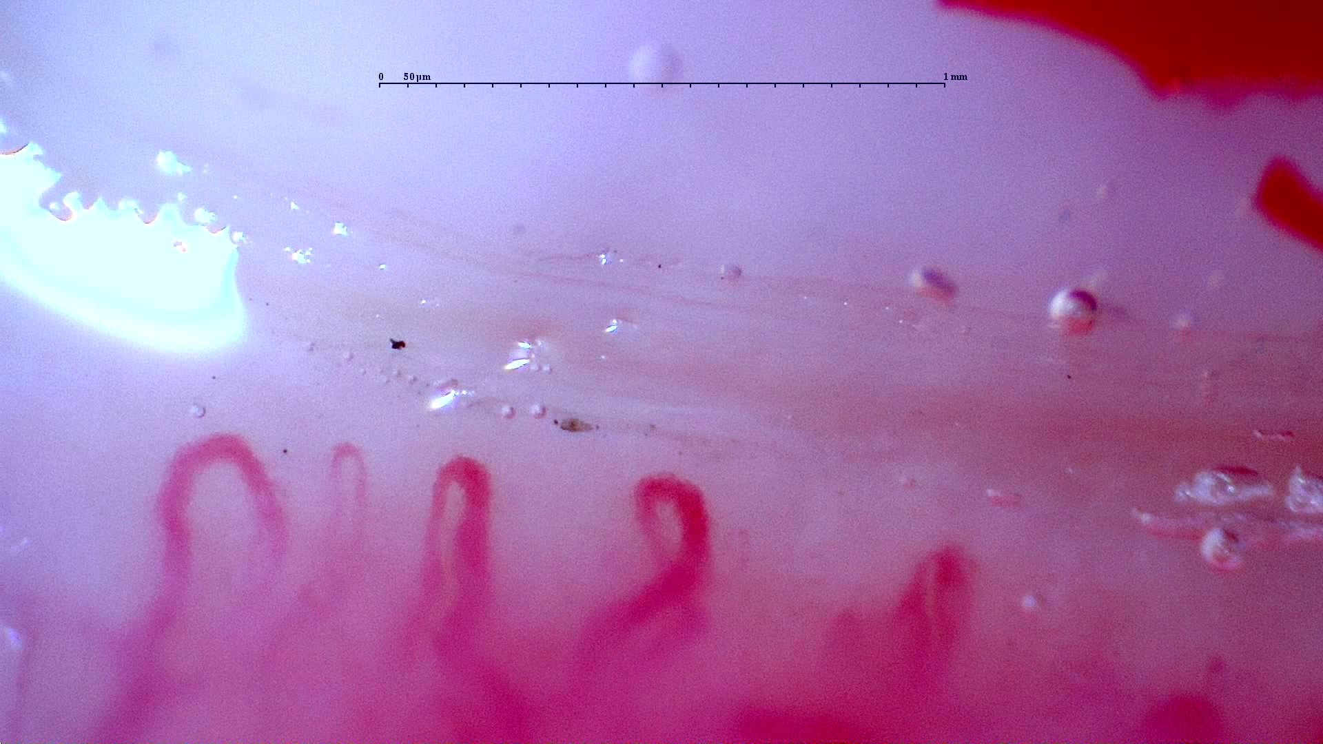 Nailfold capillaroscopy: right index finger, field b. Initial study. Anti-NXP2 Dermatomyositis with Capillaroscopic Improvement.