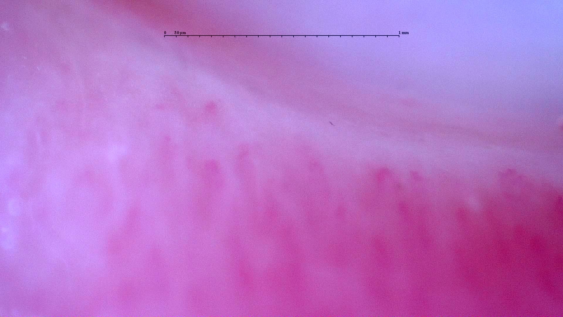 Nailfold capillaroscopy: left little finger, field d. Follow-up study. Anti-NXP2 Dermatomyositis with Capillaroscopic Improvement.