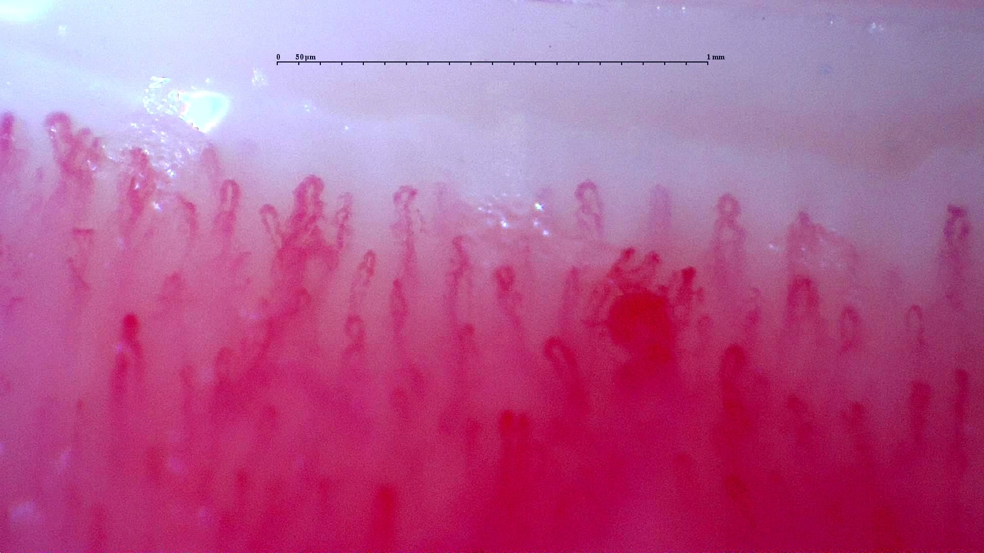 Nailfold capillaroscopy: right ring finger, field a. Follow-up study. Anti-NXP2 Dermatomyositis with Capillaroscopic Improvement.