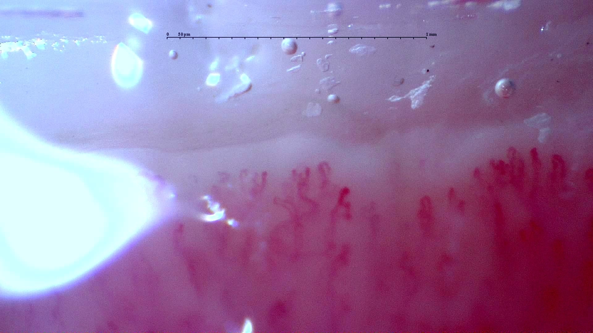 Nailfold capillaroscopy: left index finger, field b. Follow-up study. Anti-NXP2 Dermatomyositis with Capillaroscopic Improvement.