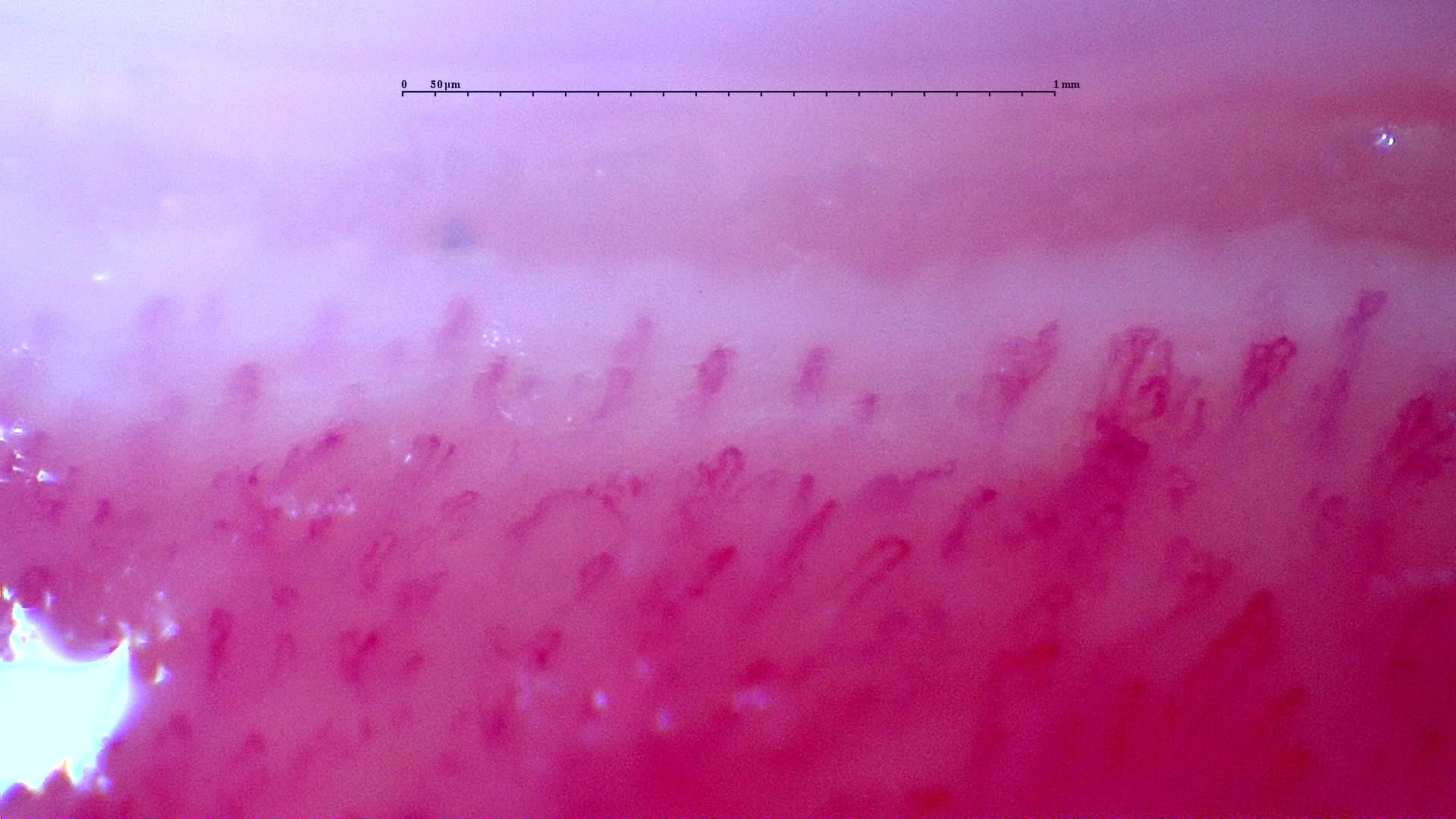Nailfold capillaroscopy: right ring finger, field d. Follow-up study. Anti-NXP2 Dermatomyositis with Capillaroscopic Improvement.
