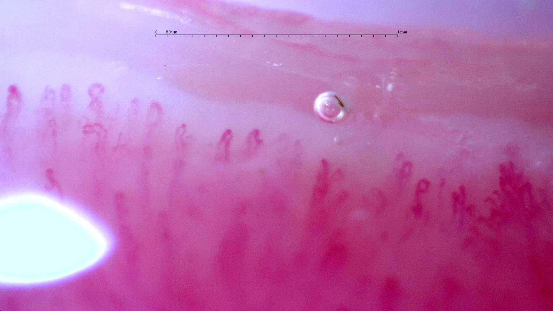 Nailfold capillaroscopy: left middle finger, field d. Follow-up study. Anti-NXP2 Dermatomyositis with Capillaroscopic Improvement.