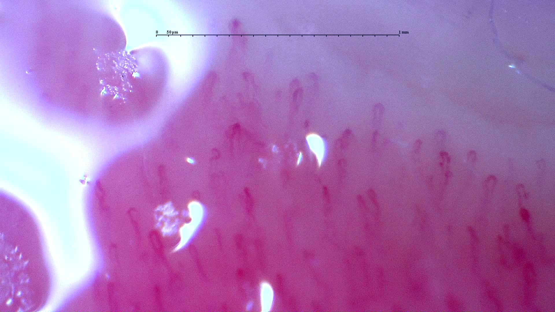 Nailfold capillaroscopy: left ring finger, field d. Follow-up study. Anti-NXP2 Dermatomyositis with Capillaroscopic Improvement.