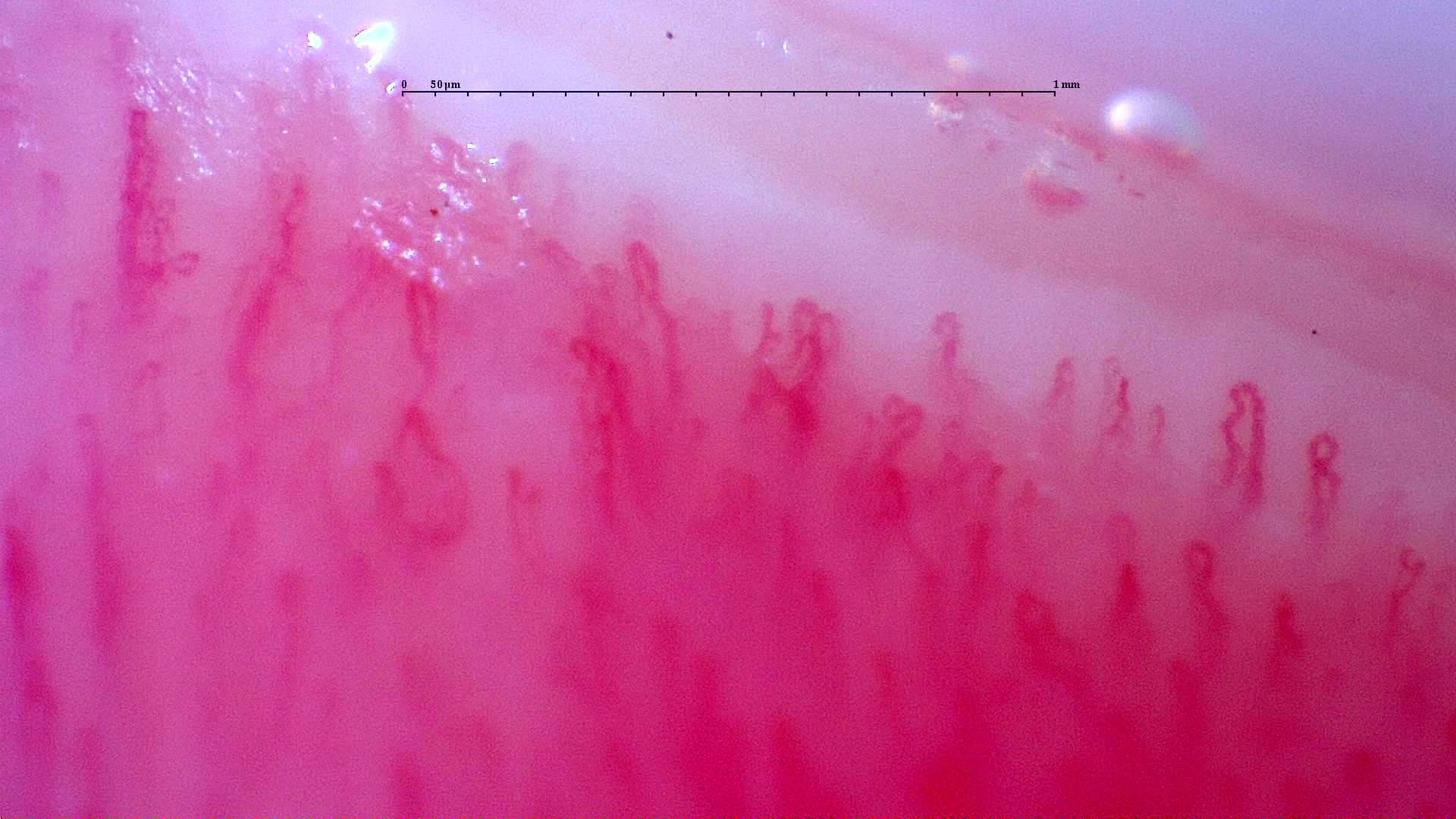 Nailfold capillaroscopy: right ring finger, field b. Follow-up study. Anti-NXP2 Dermatomyositis with Capillaroscopic Improvement.