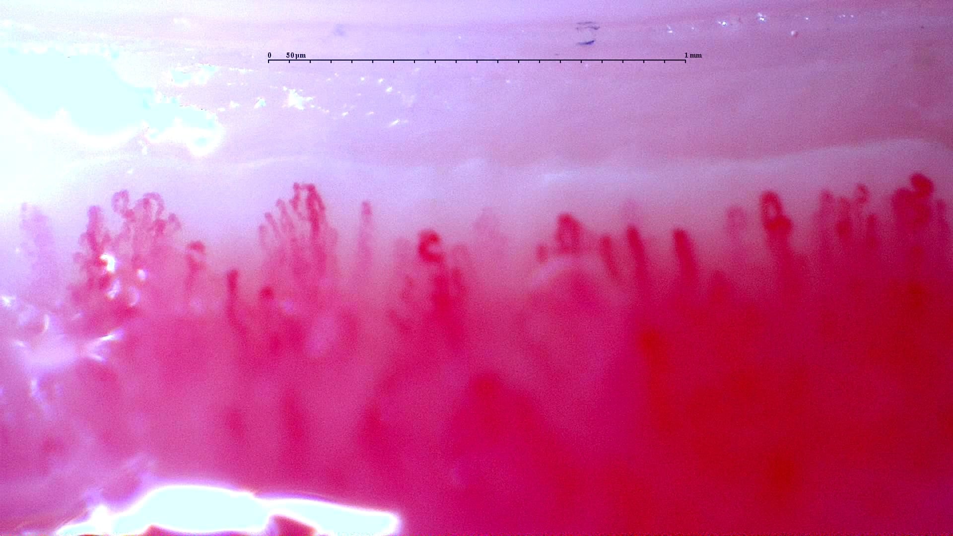Nailfold capillaroscopy: right middle finger, field d. Follow-up study. Anti-NXP2 Dermatomyositis with Capillaroscopic Improvement.