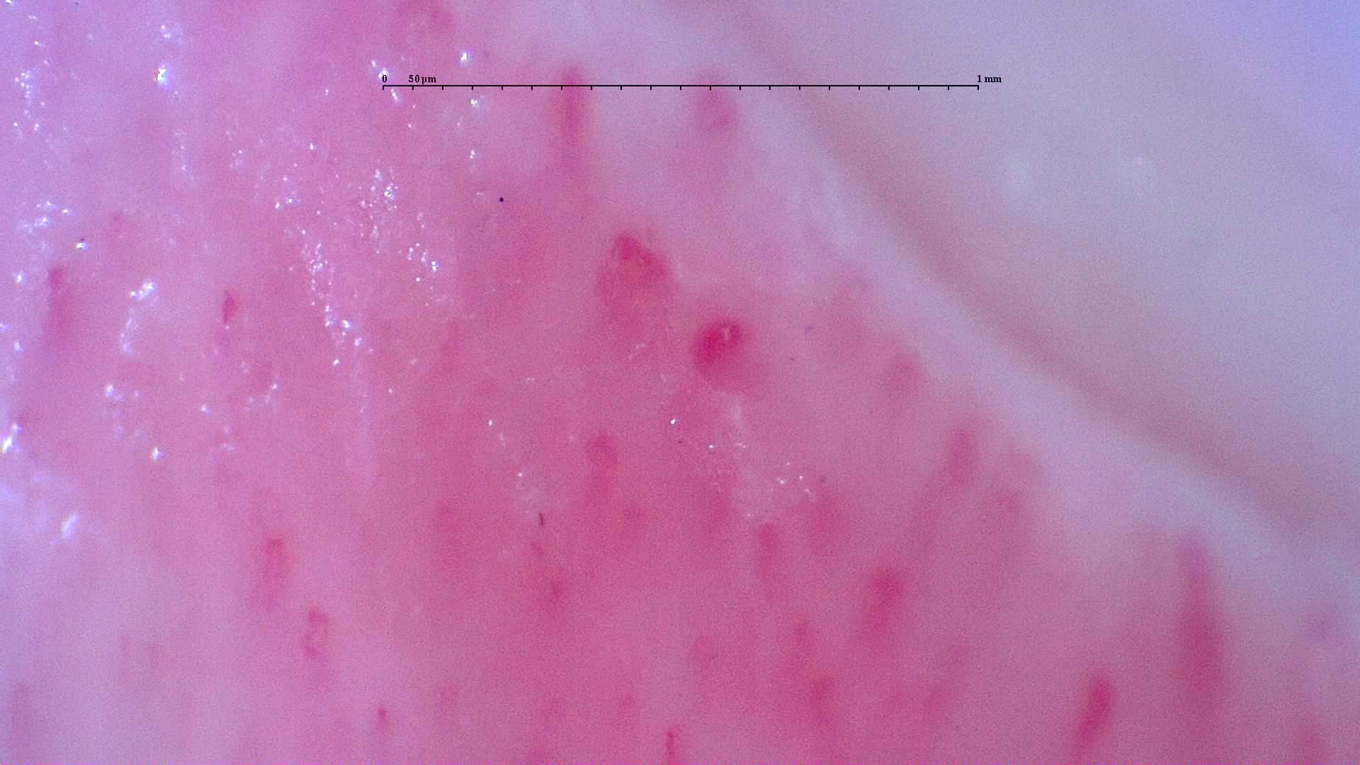 Nailfold capillaroscopy: right middle finger, field c. Follow-up study. Anti-NXP2 Dermatomyositis with Capillaroscopic Improvement.