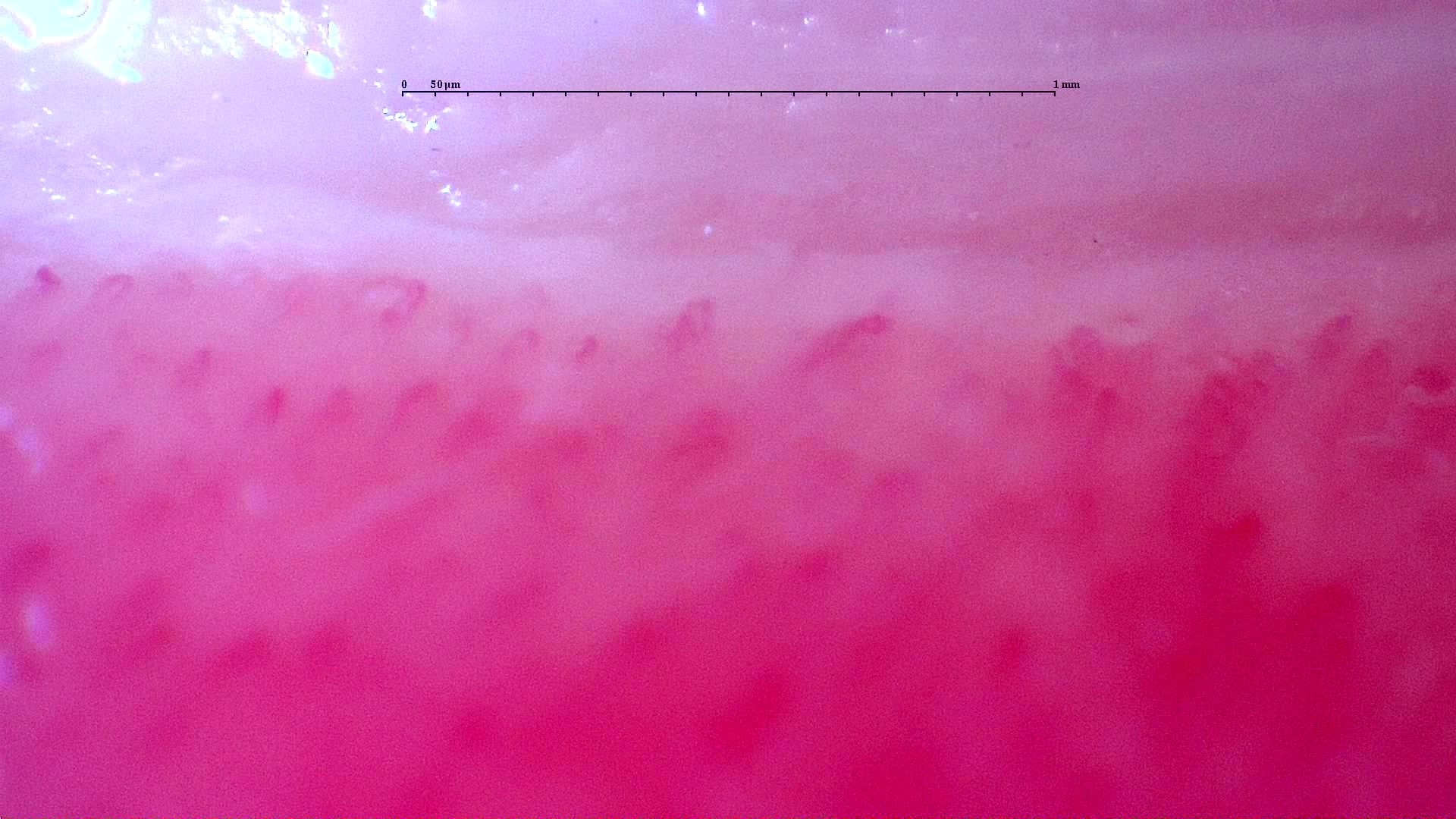 Nailfold capillaroscopy: right little finger, field c. Follow-up study. Anti-NXP2 Dermatomyositis with Capillaroscopic Improvement.