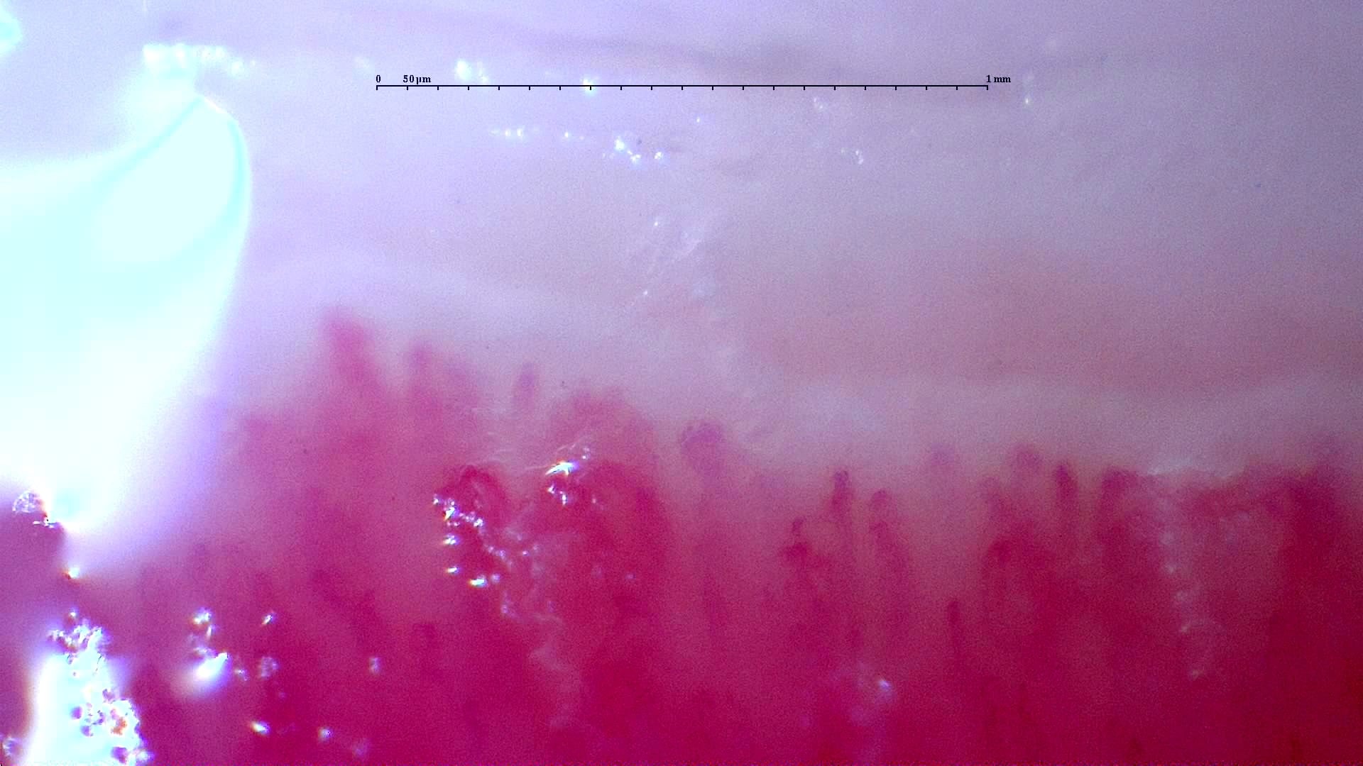 Nailfold capillaroscopy: right index finger, field b. Follow-up study. Anti-NXP2 Dermatomyositis with Capillaroscopic Improvement.