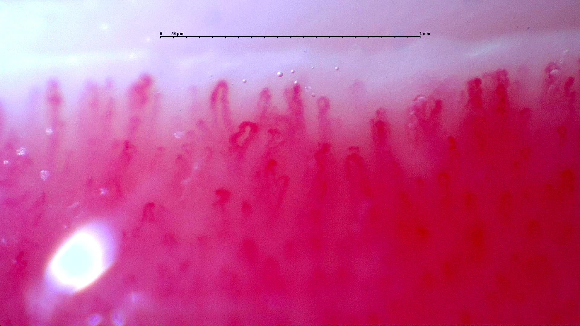 Nailfold capillaroscopy: right middle finger, field a. Follow-up study. Anti-NXP2 Dermatomyositis with Capillaroscopic Improvement.