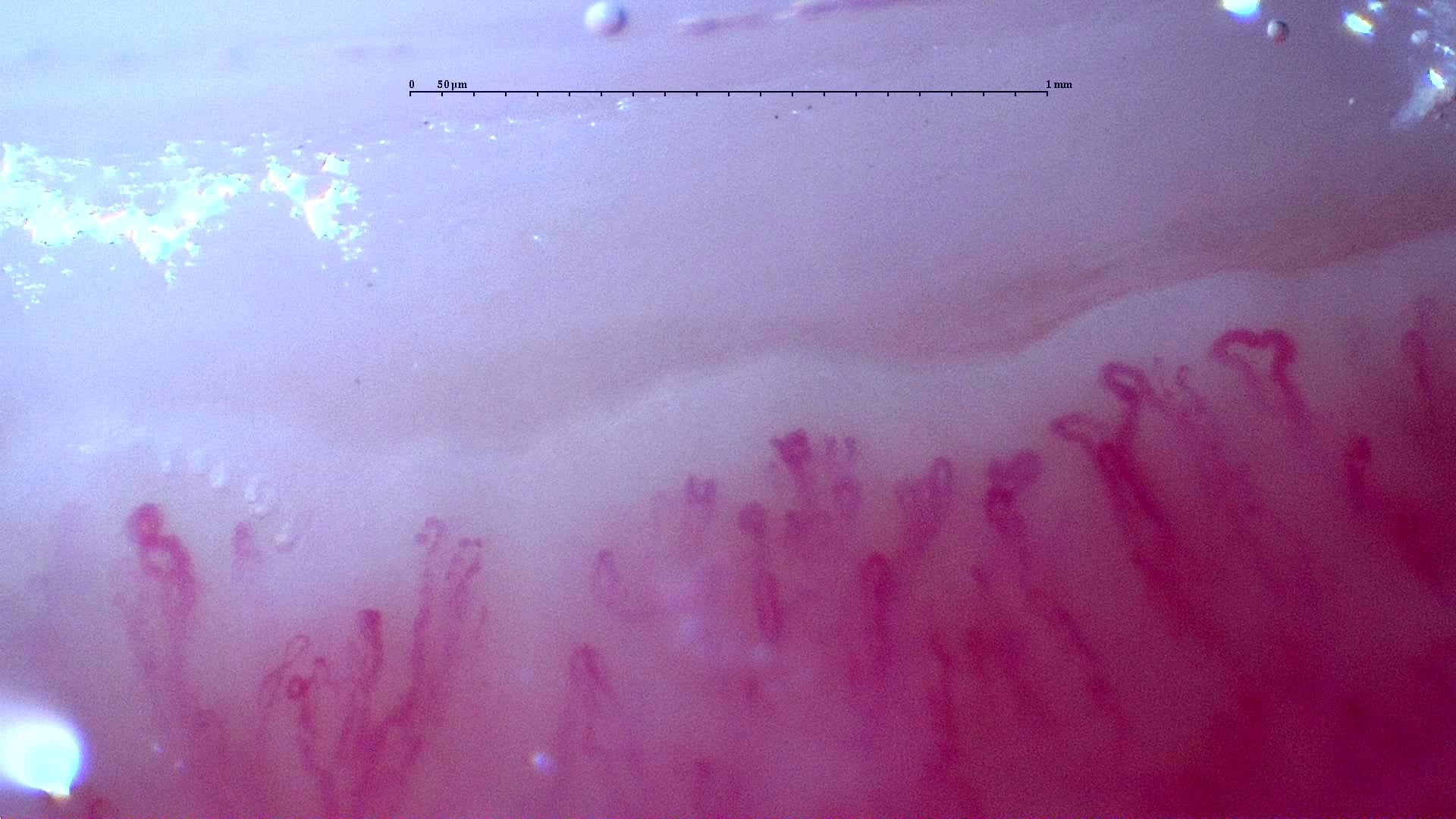 Nailfold capillaroscopy: left index finger, field c. Follow-up study. Anti-NXP2 Dermatomyositis with Capillaroscopic Improvement.