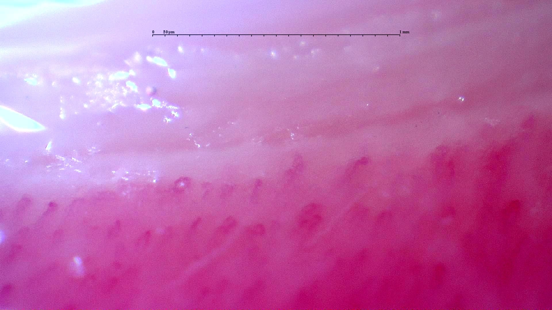 Nailfold capillaroscopy: right little finger, field a. Follow-up study. Anti-NXP2 Dermatomyositis with Capillaroscopic Improvement.