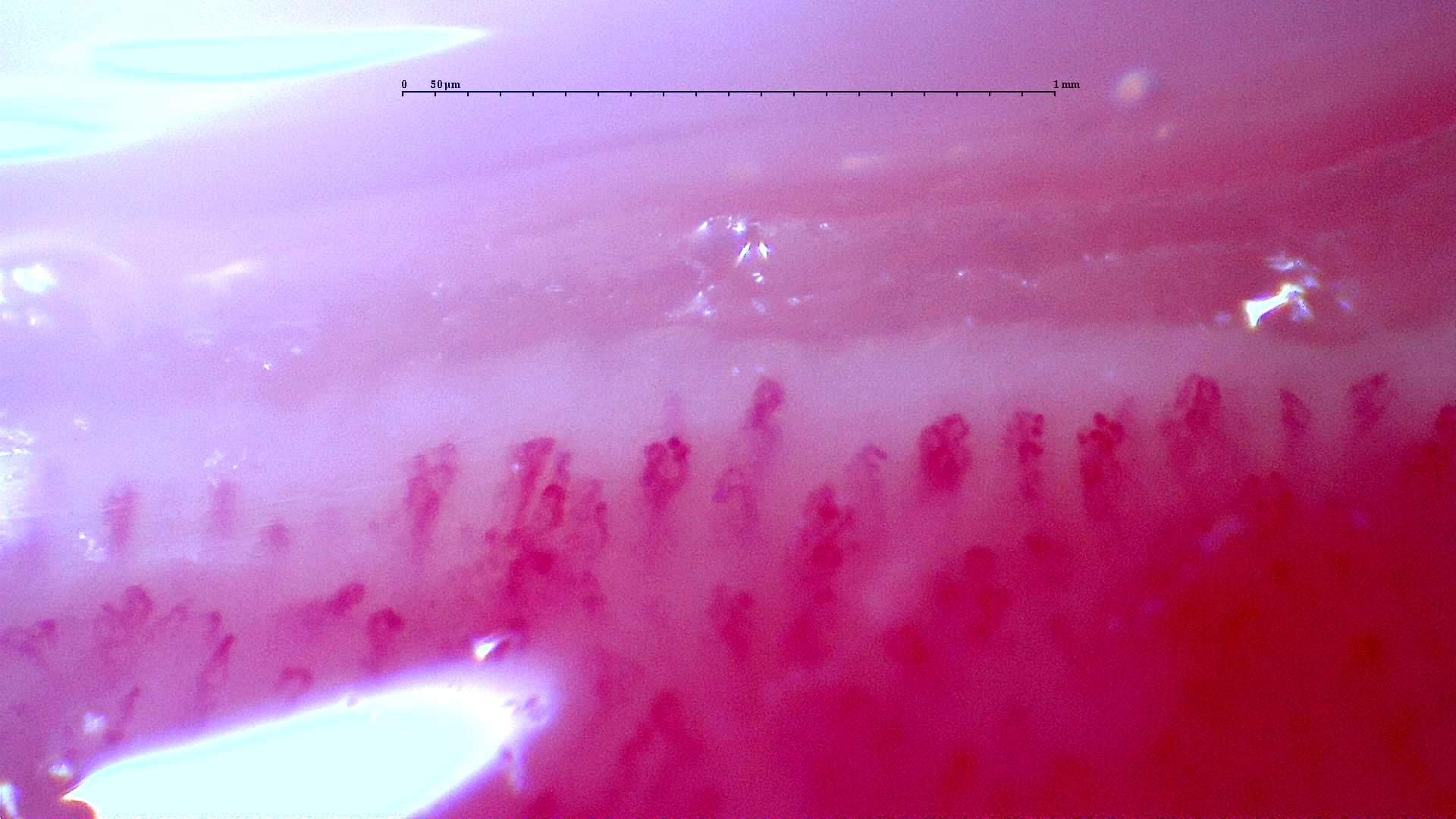 Nailfold capillaroscopy: right ring finger, field c. Follow-up study. Anti-NXP2 Dermatomyositis with Capillaroscopic Improvement.