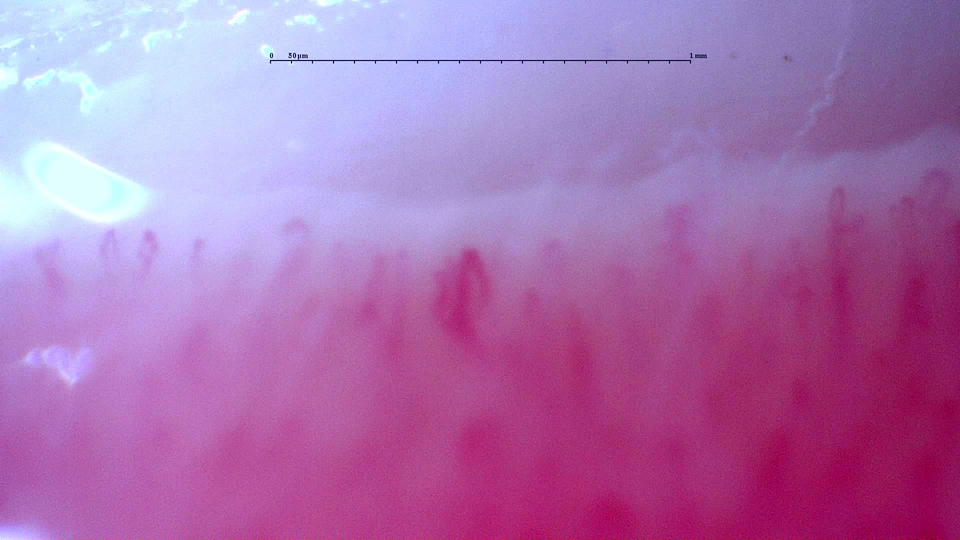 Nailfold capillaroscopy: left little finger, field a. Follow-up study. Anti-NXP2 Dermatomyositis with Capillaroscopic Improvement.