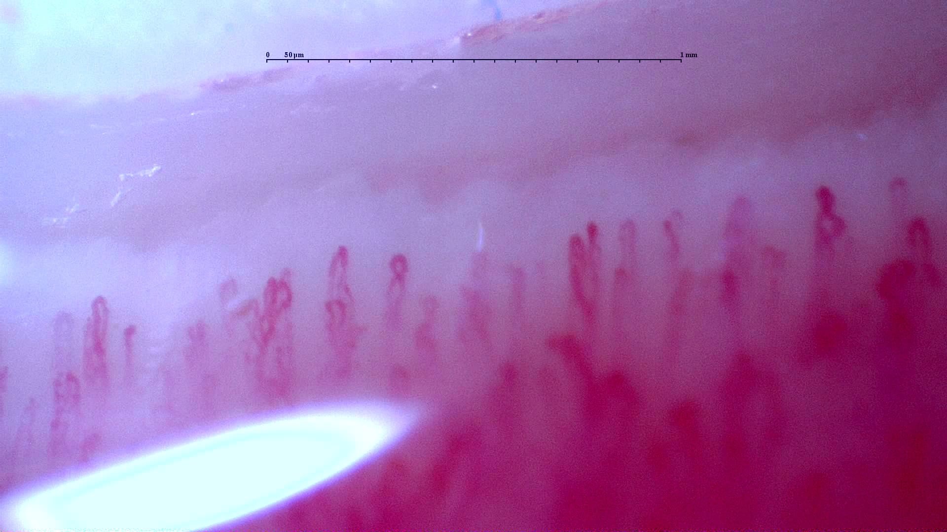Nailfold capillaroscopy: left middle finger, field a. Follow-up study. Anti-NXP2 Dermatomyositis with Capillaroscopic Improvement.