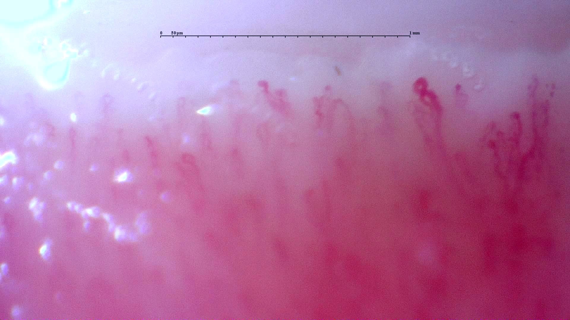 Nailfold capillaroscopy: left index finger, field d. Follow-up study. Anti-NXP2 Dermatomyositis with Capillaroscopic Improvement.