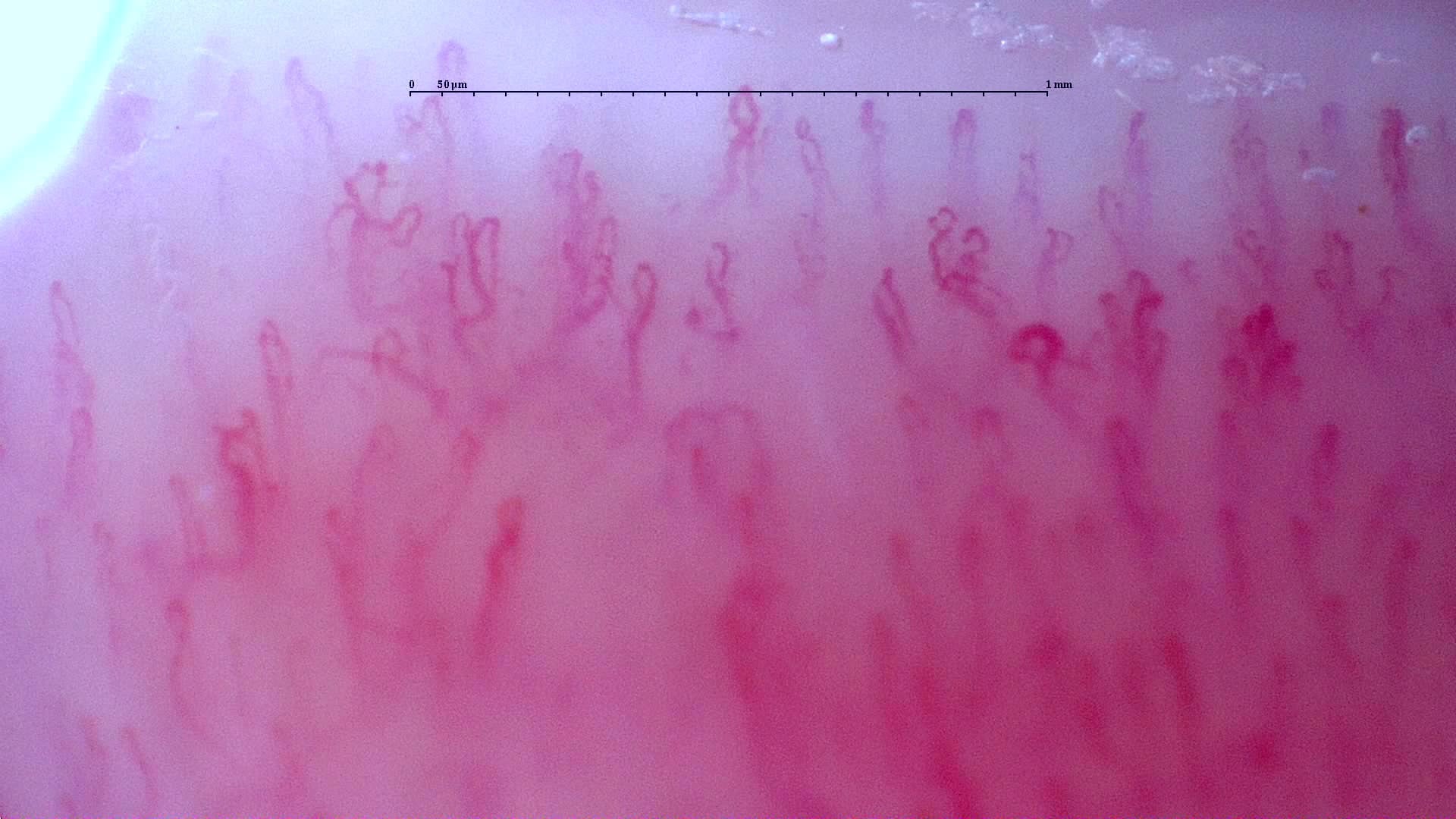 Nailfold capillaroscopy: left ring finger, field b. Follow-up study. Anti-NXP2 Dermatomyositis with Capillaroscopic Improvement.