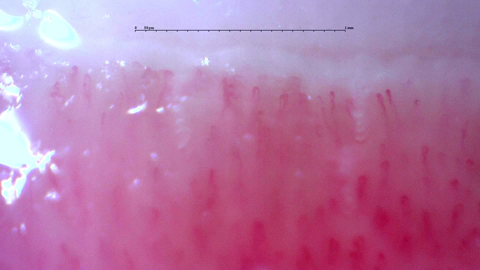 Nailfold capillaroscopy: right index finger, field c. Follow-up study. Anti-NXP2 Dermatomyositis with Capillaroscopic Improvement.