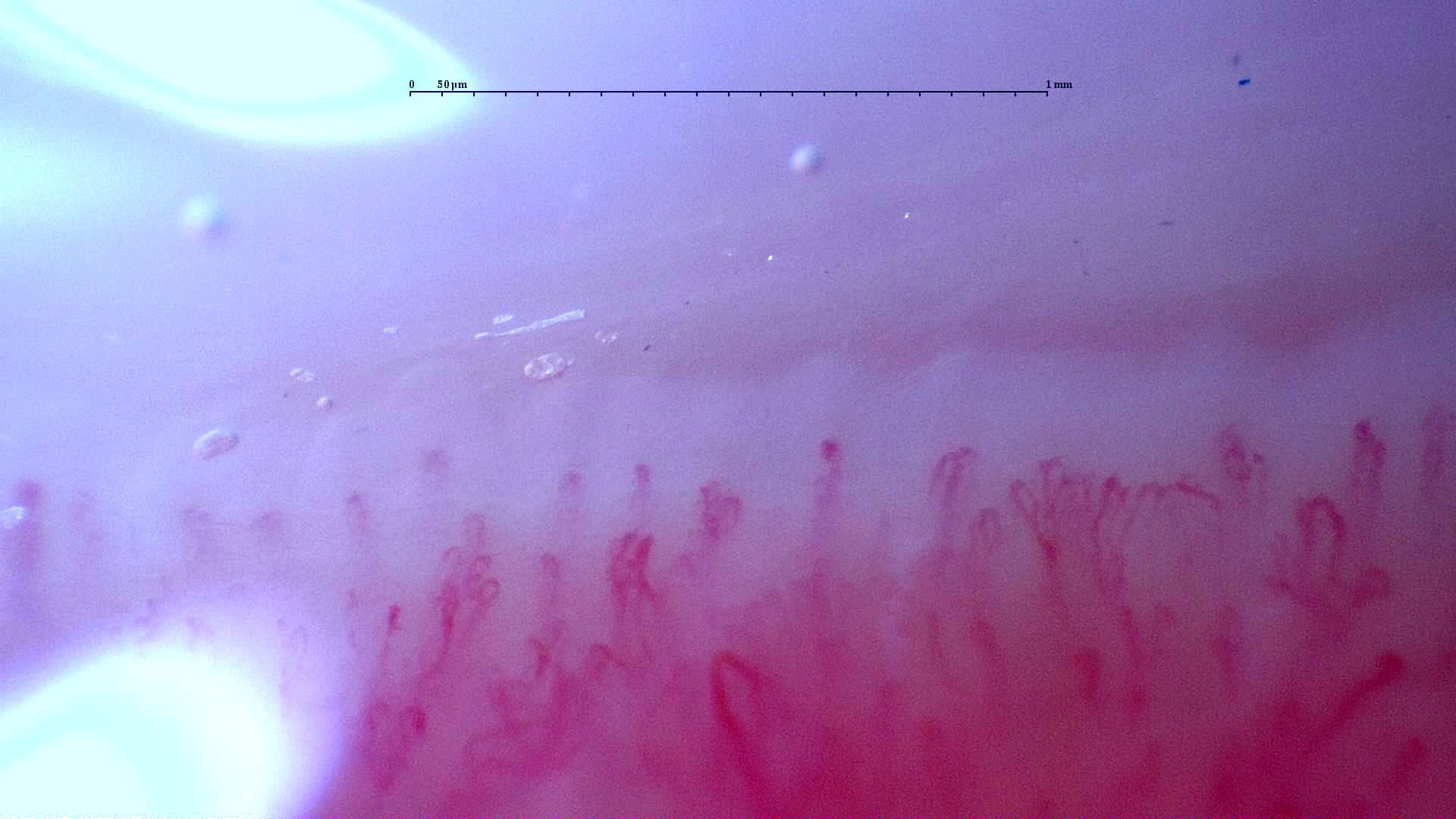Nailfold capillaroscopy: left ring finger, field a. Follow-up study. Anti-NXP2 Dermatomyositis with Capillaroscopic Improvement.