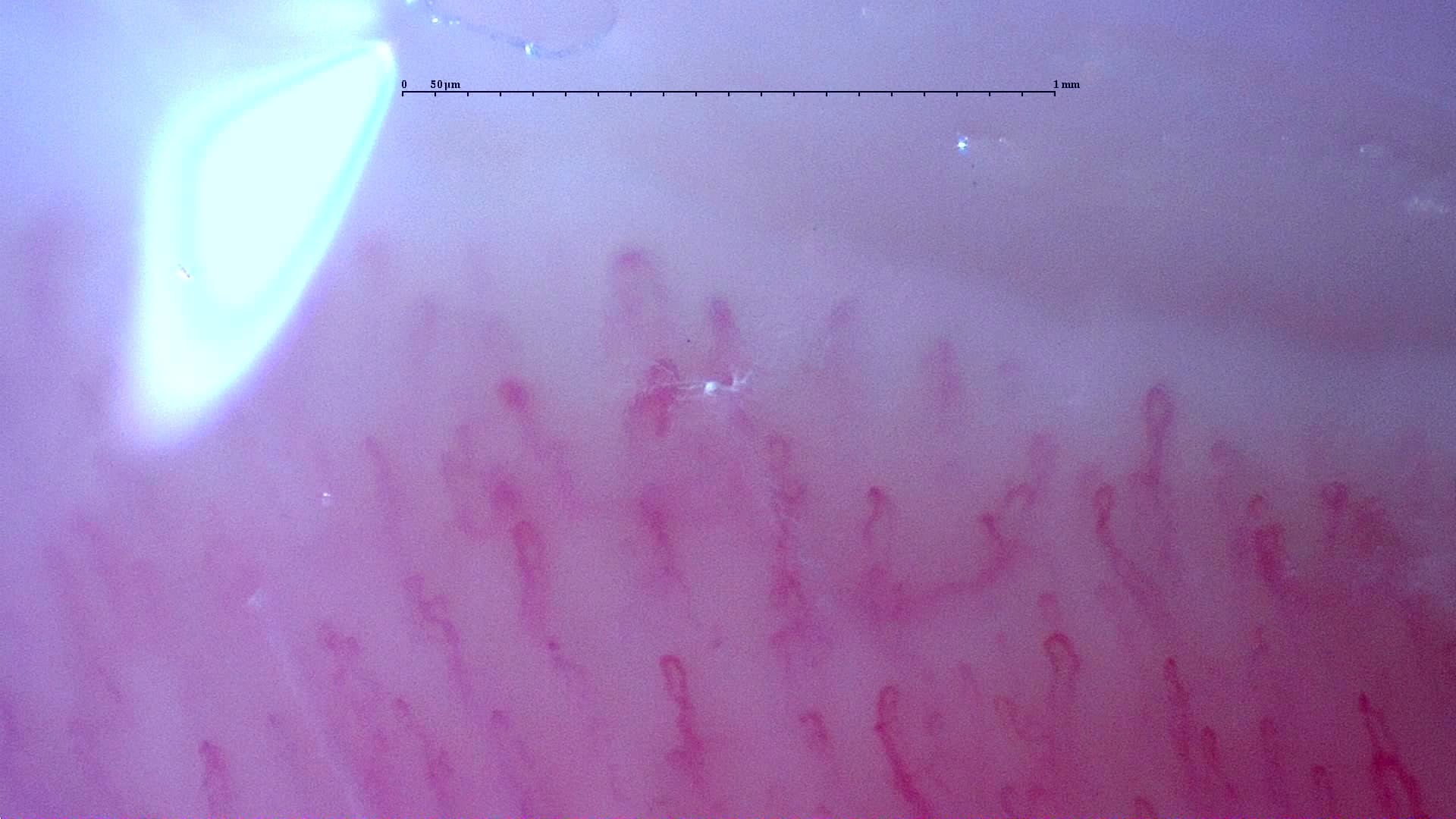 Nailfold capillaroscopy: left ring finger, field c. Follow-up study. Anti-NXP2 Dermatomyositis with Capillaroscopic Improvement.