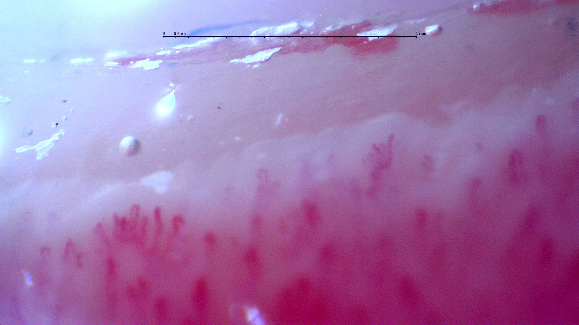 Nailfold capillaroscopy: left index finger, field a. Follow-up study. Anti-NXP2 Dermatomyositis with Capillaroscopic Improvement.