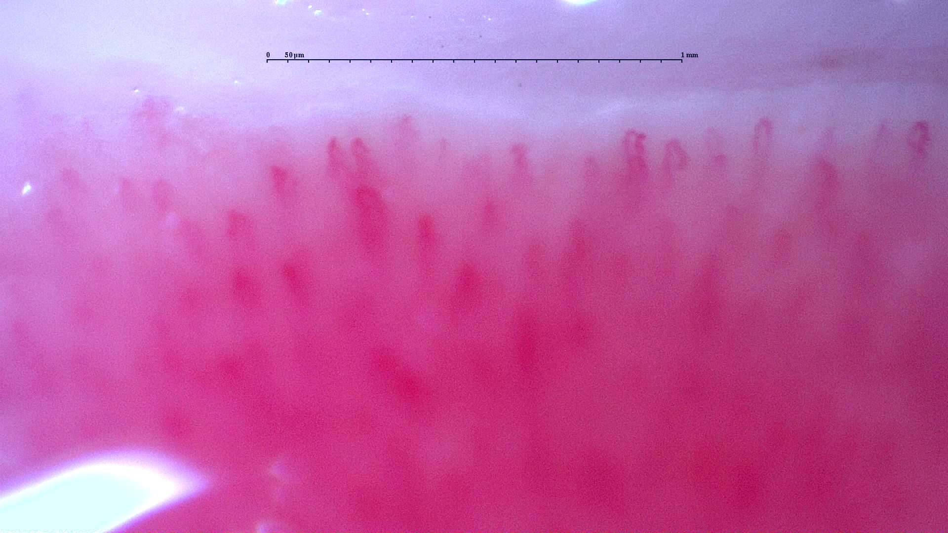 Nailfold capillaroscopy: left little finger, field b. Follow-up study. Anti-NXP2 Dermatomyositis with Capillaroscopic Improvement.