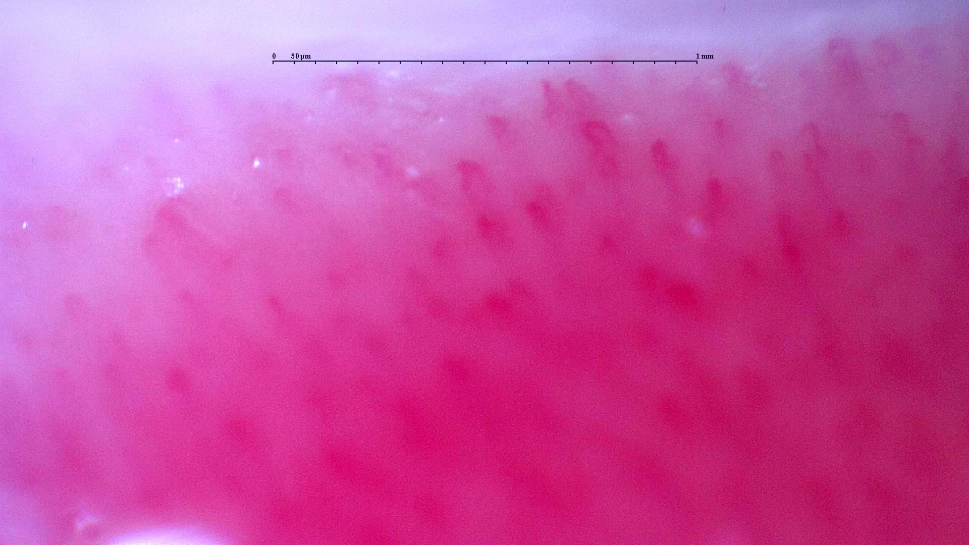Nailfold capillaroscopy: left little finger, field c. Follow-up study. Anti-NXP2 Dermatomyositis with Capillaroscopic Improvement.