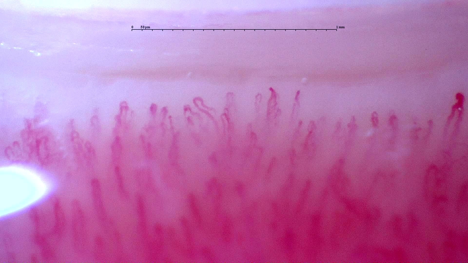 Nailfold capillaroscopy: left middle finger, field c. Follow-up study. Anti-NXP2 Dermatomyositis with Capillaroscopic Improvement.