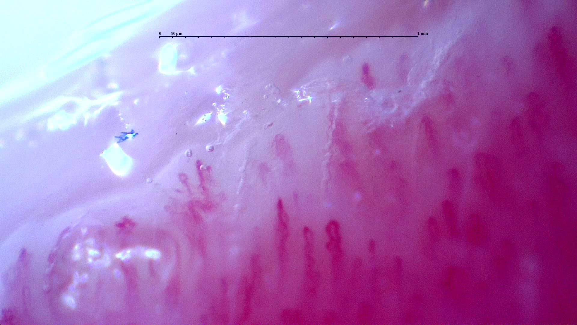 Nailfold capillaroscopy: right middle finger, field b. Follow-up study. Anti-NXP2 Dermatomyositis with Capillaroscopic Improvement.
