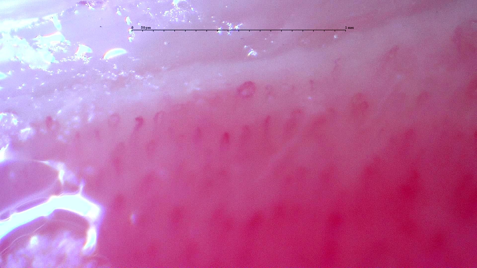 Nailfold capillaroscopy: right little finger, field b. Follow-up study. Anti-NXP2 Dermatomyositis with Capillaroscopic Improvement.