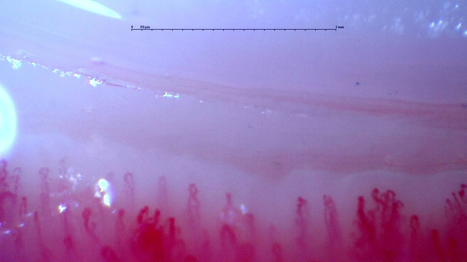 Nailfold capillaroscopy: right index finger, field d. Follow-up study. Anti-NXP2 Dermatomyositis with Capillaroscopic Improvement.