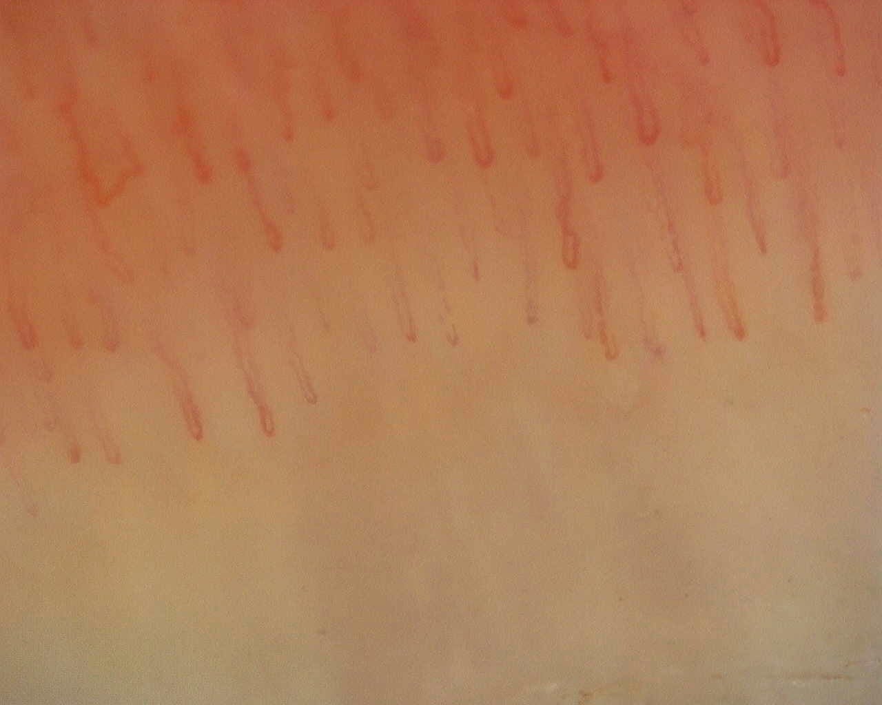 Nailfold capillaroscopy: left little finger, field b. Non-Specific Pattern: Representative Case.