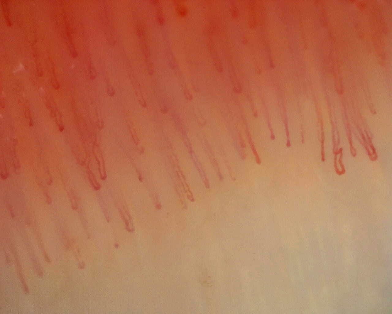 Nailfold capillaroscopy: right little finger, field d. Non-Specific Pattern: Representative Case.