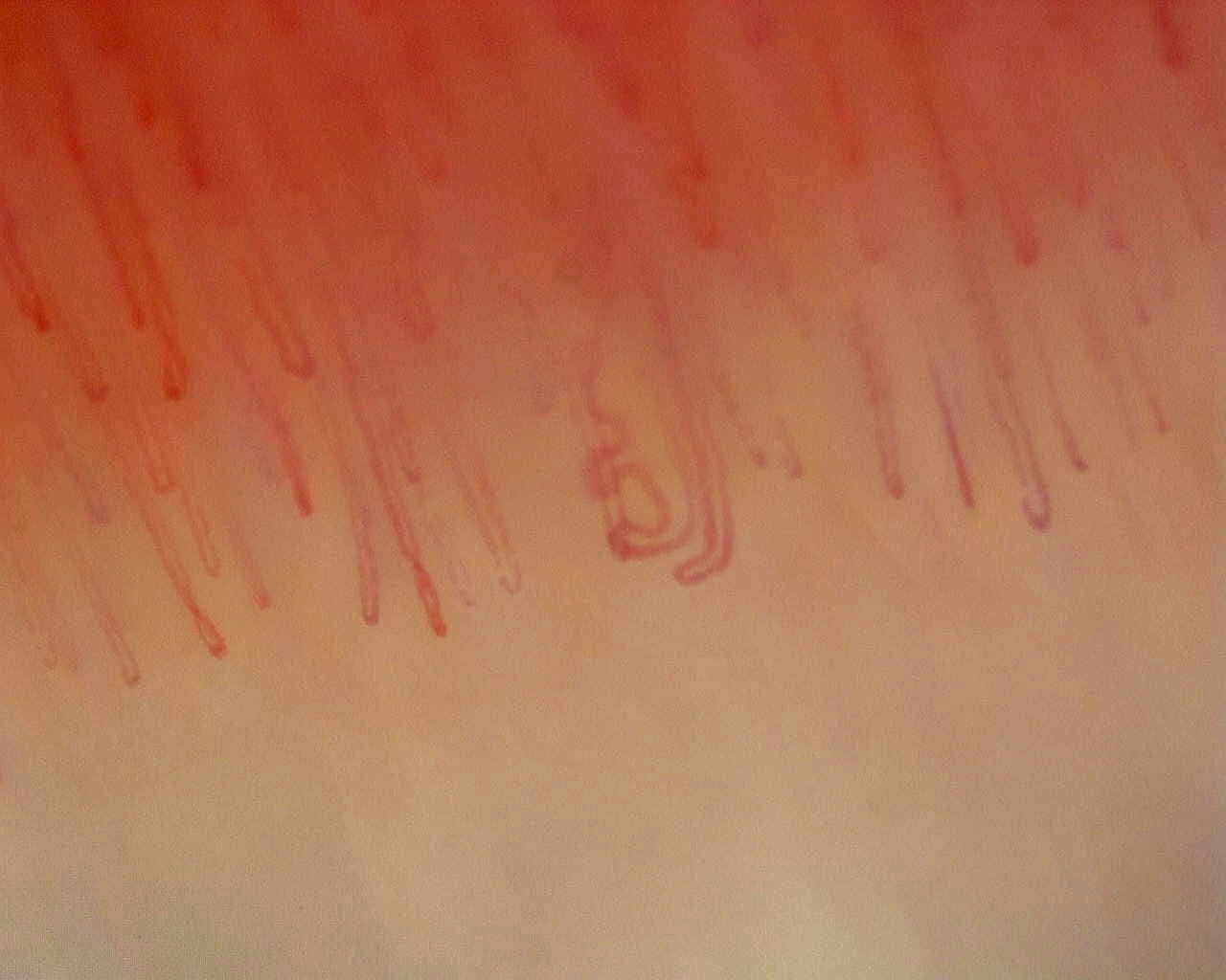 Nailfold capillaroscopy: right little finger, field c. Non-Specific Pattern: Representative Case.