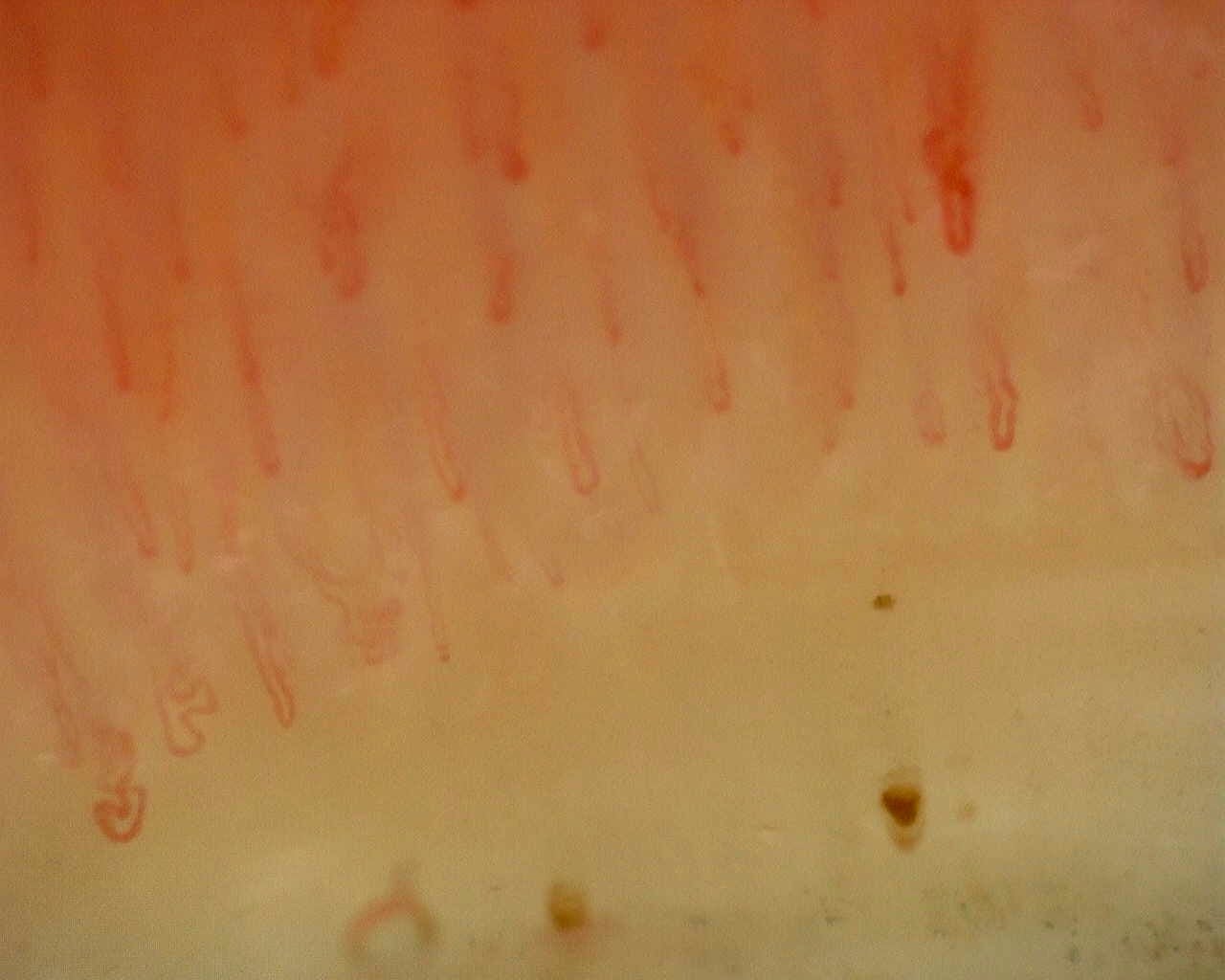 Nailfold capillaroscopy: right index finger, field c. Non-Specific Pattern: Representative Case.