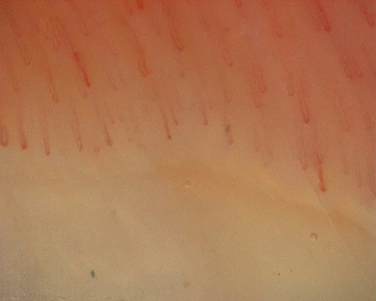 Nailfold capillaroscopy: left little finger, field d. Non-Specific Pattern: Representative Case.