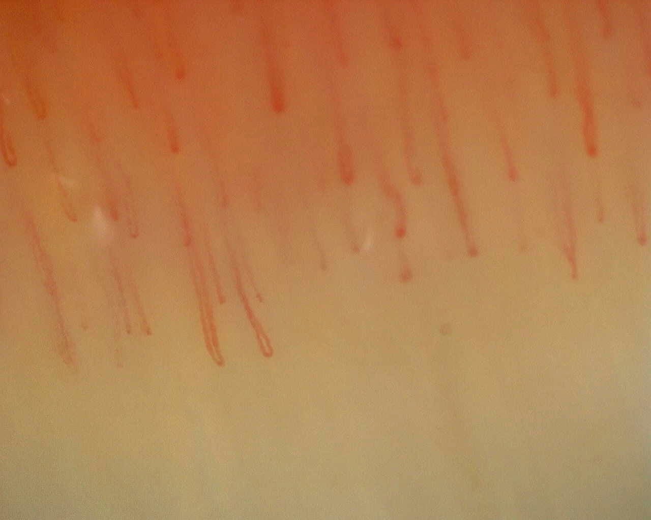 Nailfold capillaroscopy: right ring finger, field c. Non-Specific Pattern: Representative Case.