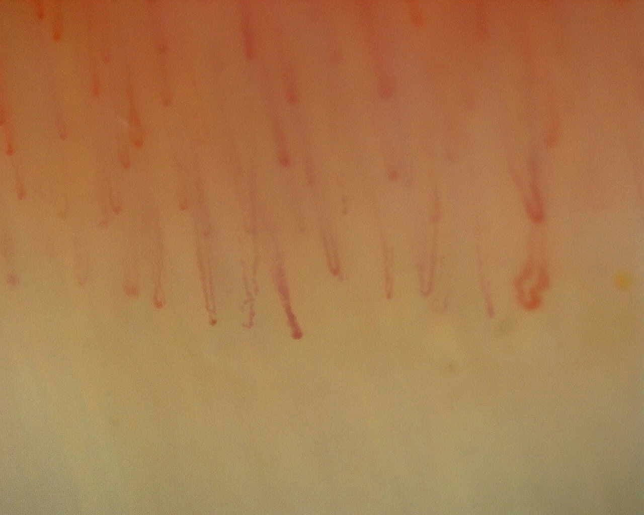 Nailfold capillaroscopy: right ring finger, field b. Non-Specific Pattern: Representative Case.