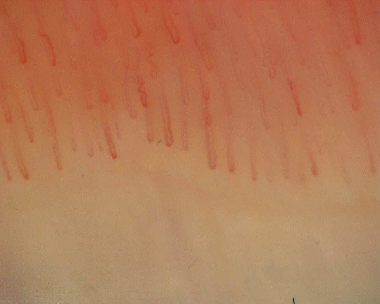 Nailfold capillaroscopy: left little finger, field c. Non-Specific Pattern: Representative Case.