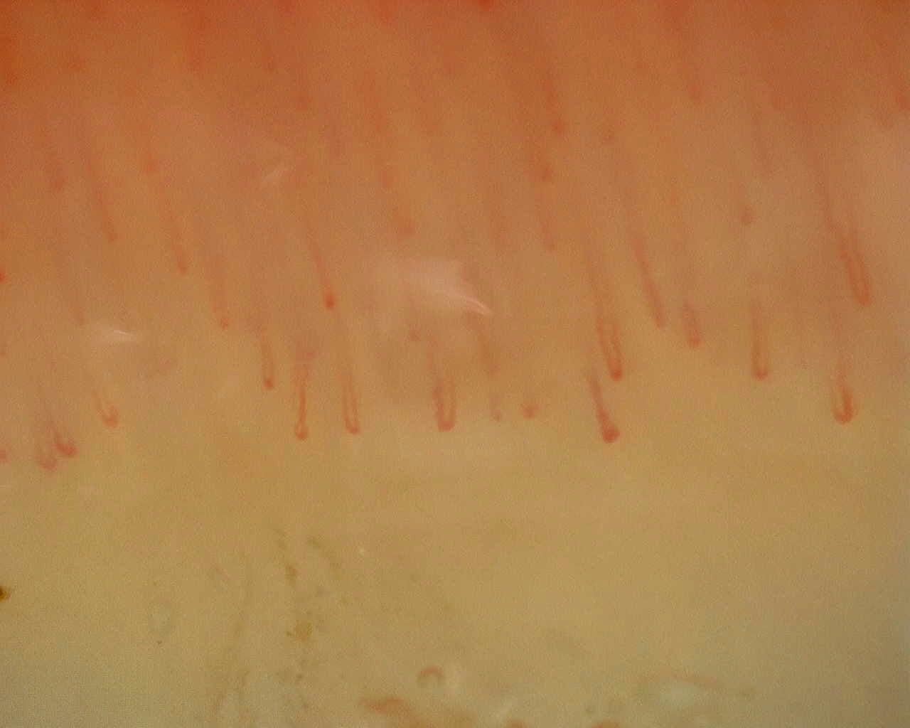 Nailfold capillaroscopy: right middle finger, field b. Non-Specific Pattern: Representative Case.