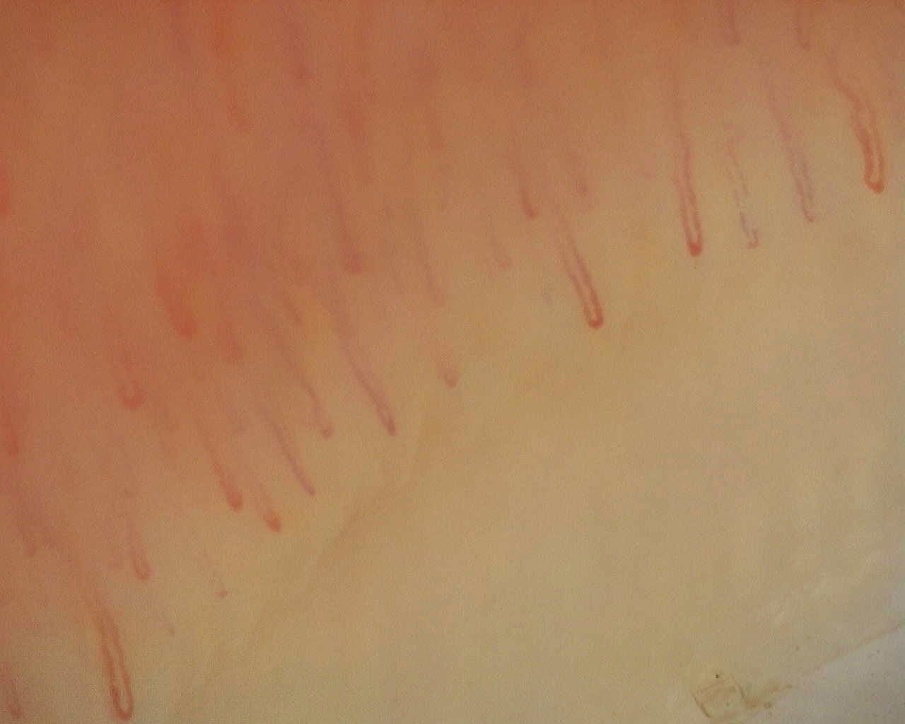 Nailfold capillaroscopy: left little finger, field a. Non-Specific Pattern: Representative Case.