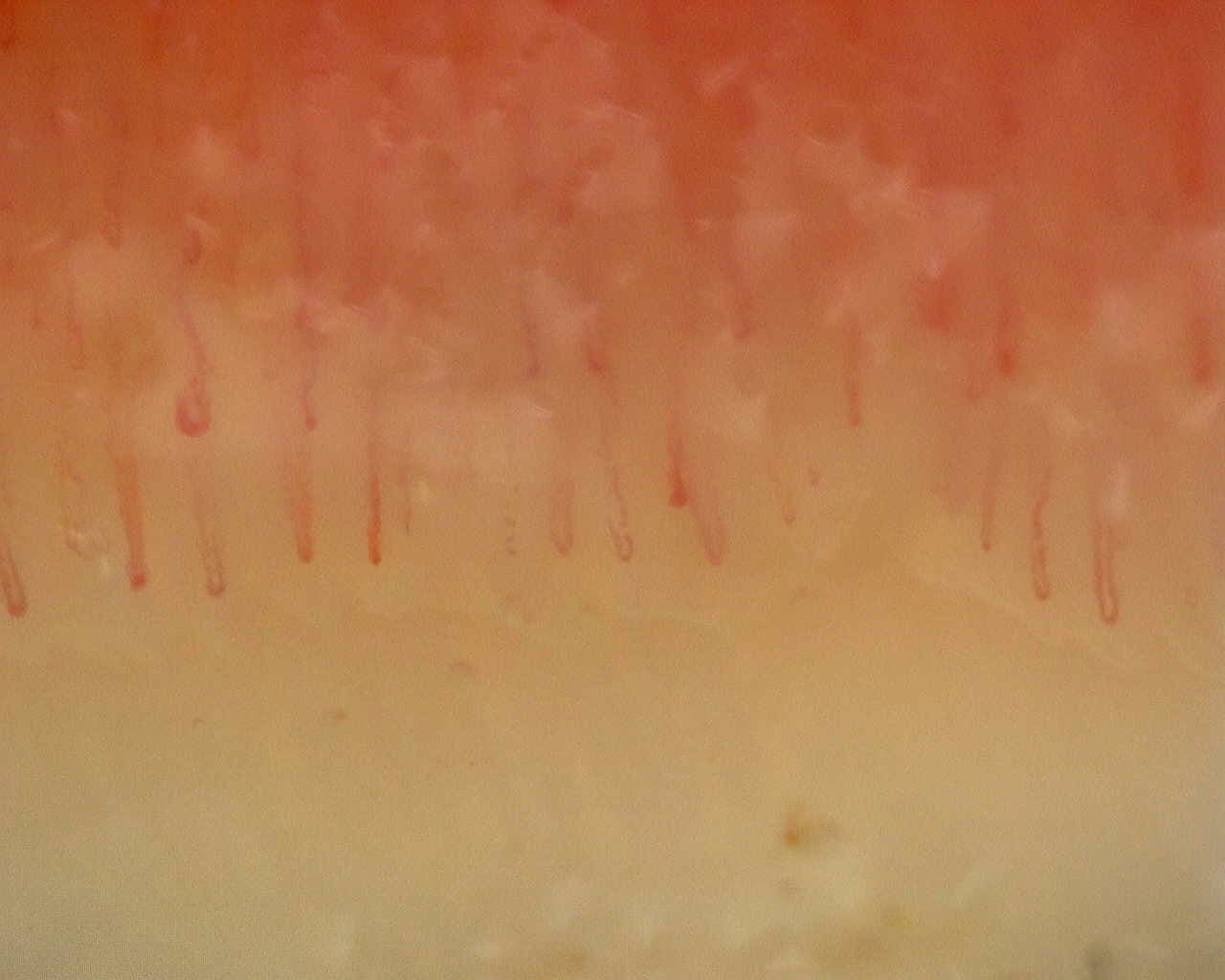 Nailfold capillaroscopy: left index finger, field c. Non-Specific Pattern: Representative Case.