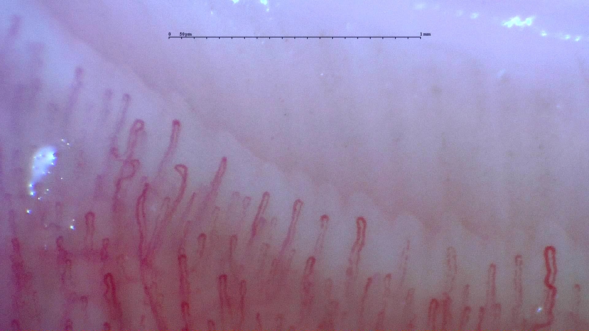 Nailfold capillaroscopy: left little finger, field c. Normal Pattern: Representative Case.