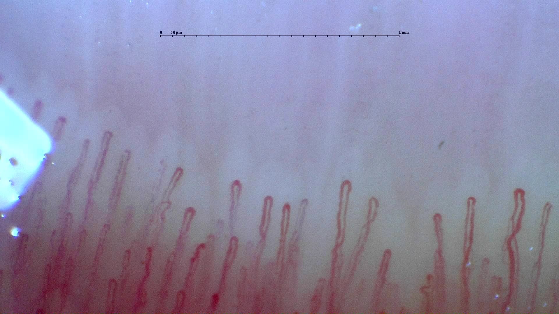 Nailfold capillaroscopy: left ring finger, field b. Normal Pattern: Representative Case.